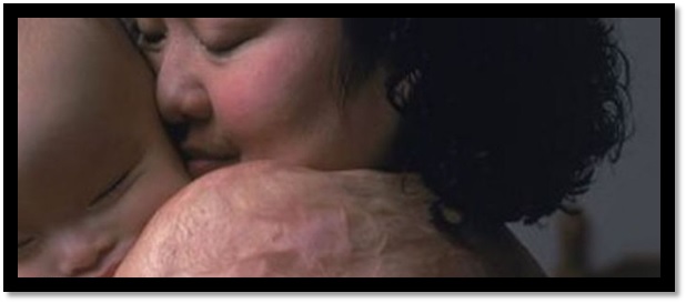 Kim Phuc, símbolo de Vietnam, y las cicatrices que le dejó el napalm. Crédito: BBC News