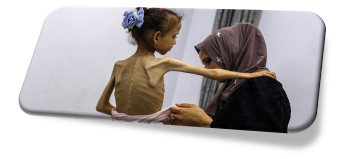 Una niña pequeña con desnutrición grave recibe ayuda para vestirse.