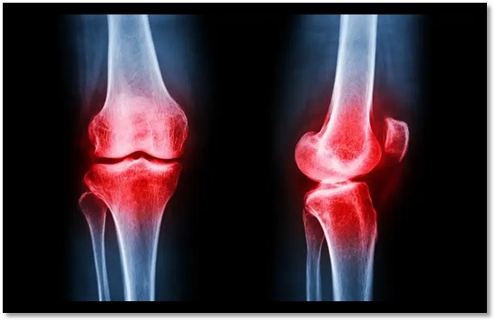 Descubren una molécula natural capaz de proteger el cartílago y frenar el desgaste de las rodillas :: Asdigitalnews